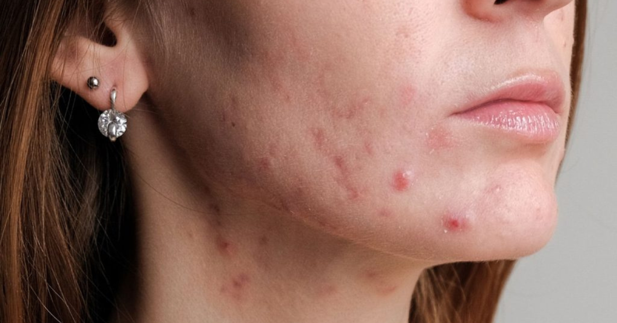 La mejor crema hidratante para piel acneica